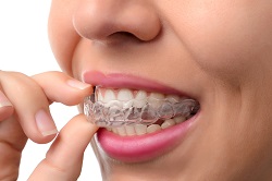woman holding clear teeth aligners in mouth Invisalign treatment Annapolis, MD
